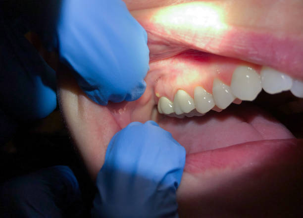 Best Emergency Dental Care for Abscessed Tooth in Electra, TX